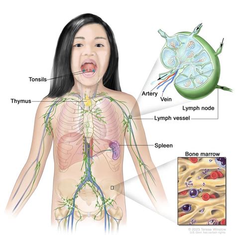 Childhood Hodgkin Lymphoma Treatment (PDQ®)–Patient Version - Siteman ...