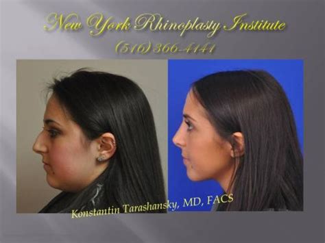 Patient Gallery | New York Rhinoplasty