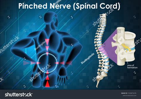 Diagram Showing Pinched Nerve On Human Stock Vector (Royalty Free ...