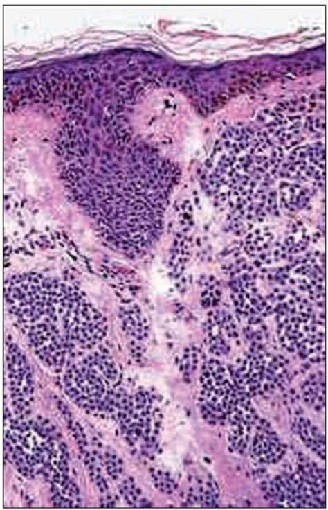 Histopathology showing varying proportions of melanocyt | Open-i