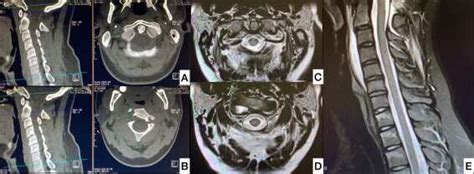 A: CT C1-C2 rotary subluxation, B: CT Hangman's fracture, C: MRI intact... | Download Scientific ...