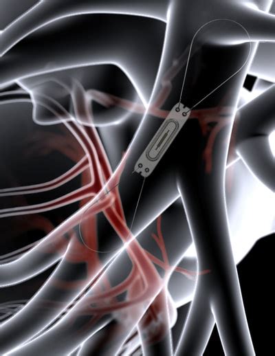 Cardiomems device - Wessex Cardiology