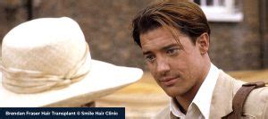 Brendan Fraser Hair Transplant - Smile Hair Clinic