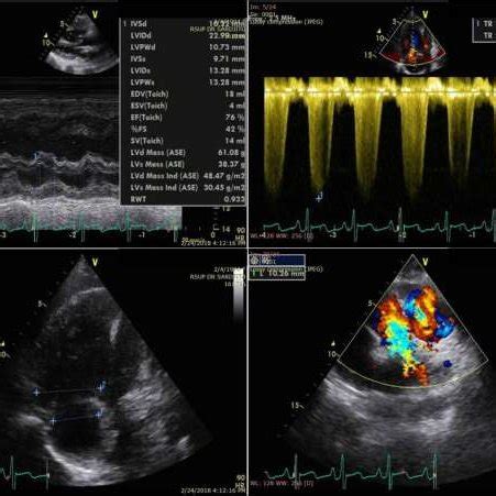 Transthoracal echocardiography examination showed bidirectional shunt... | Download Scientific ...