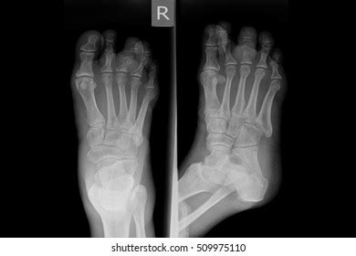 Xray Right Foot Show Closed Fracture Stock Photo 509975110 | Shutterstock