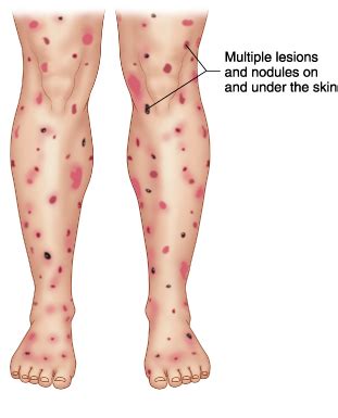 [Solved] Which is the most common HIV related malignancy?