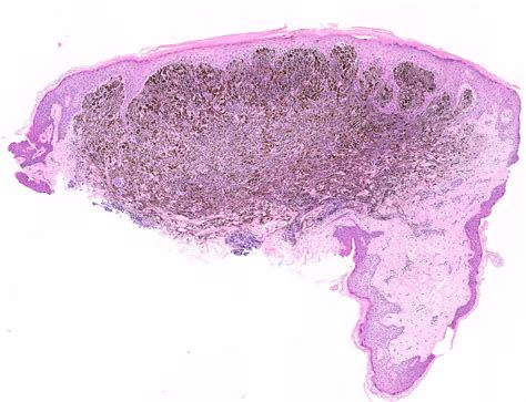 Nodular Melanoma Histology