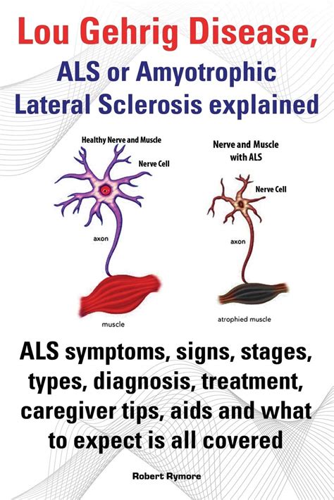 Buy Lou Gehrig Disease, ALS or Amyotrophic Lateral Sclerosis explained ...