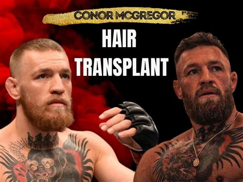 Conor McGregor Hair Transplant - Hair Loss & Technical Analysis