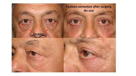 The Direct Excision of Eyelid Festoons | Laser skin, Excision, Under eye bags