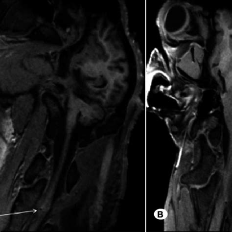 Magnetic Resonance Imaging reveals the lesion at the spinothalamic... | Download Scientific Diagram