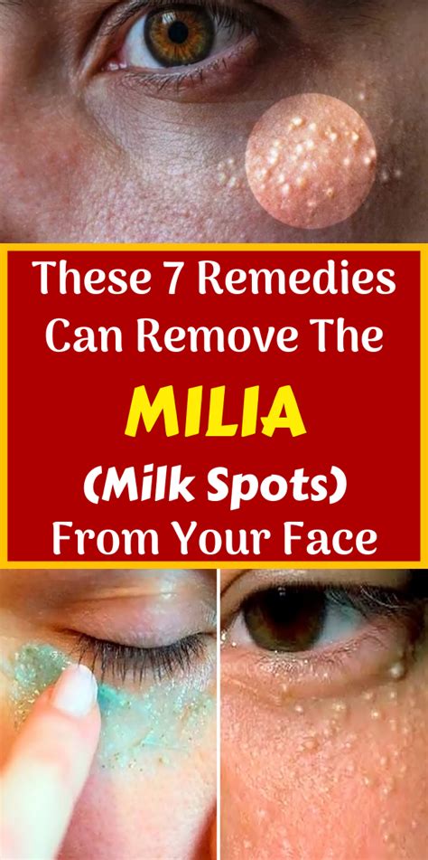 These 7 Remedies Can Remove The Milia (Milk Spots) From Your Face ...