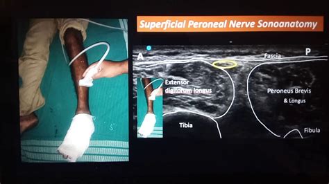 Ultrasound guided ankle block