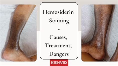 Hemosiderin Staining 101; Symptoms, Causes and Treatment : r/publichealth