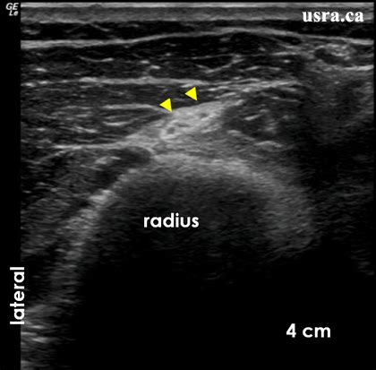 Radial Nerve: Ultrasound Radial Nerve Block At Elbow