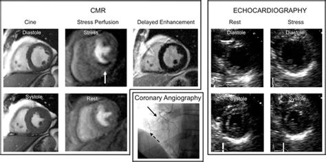 Stress Cardiac MR Imaging Compared with Stress Echocardiography in the ...