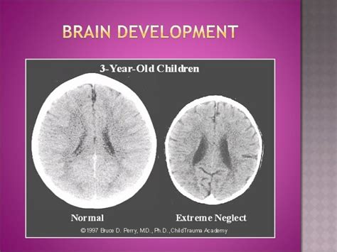 Early Childhood Trauma and Brain Development