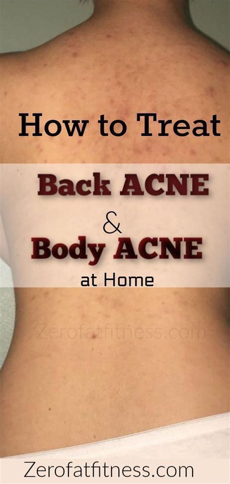 How to Get Rid of Back Acne Overnight at Home - 9 Natural Remedies for Back Acne #backacne # ...