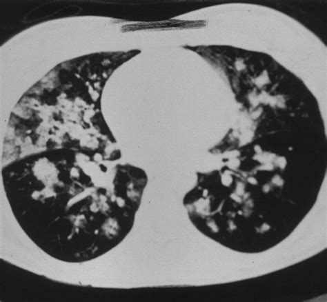 Clinical and Radiologic Features of Pulmonary Edema | RadioGraphics