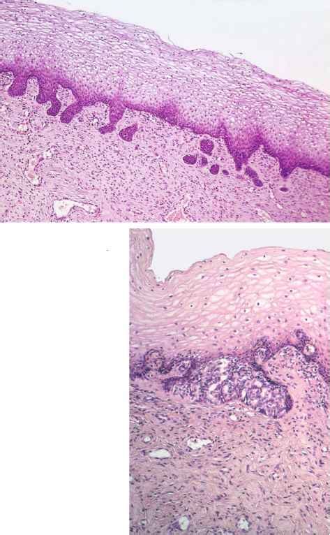 Normal Ectocervix Figs - Cell Differentiation