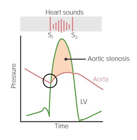 Aortic Stenosis Murmur