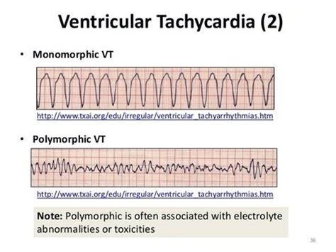 Cardio - Ventricular tachycardia Flashcards | Quizlet