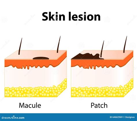 Skin Lesions Type Macule Papule