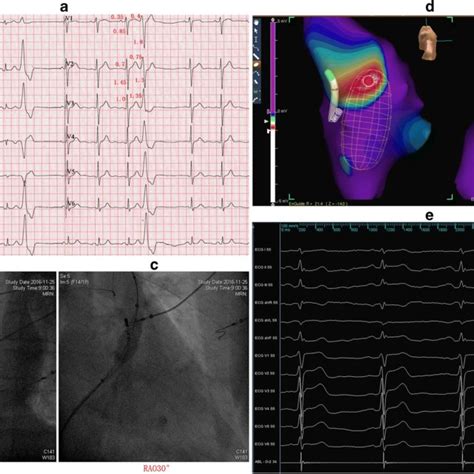 a Successful ablation of a PVC originating from the right coronary cusp ...