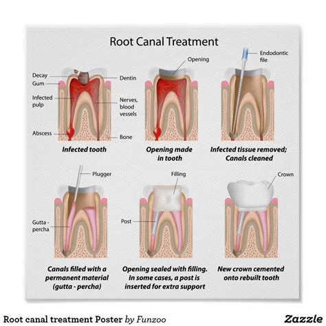 After Root Canal Treatment Swelling