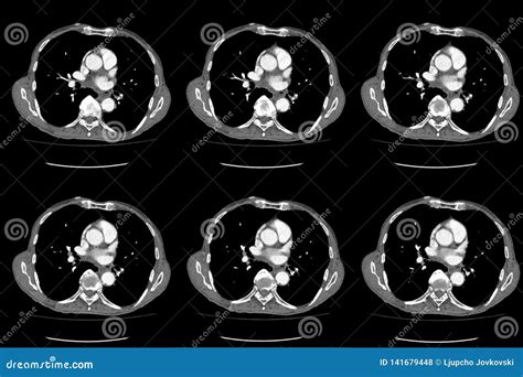 Computed Tomography CT Whole Abdomen in Axial. Part Six Stock Photo - Image of concept ...