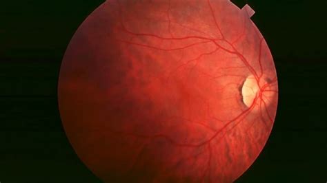 Latest Retinitis Pigmentosa Treatment Available Now in India