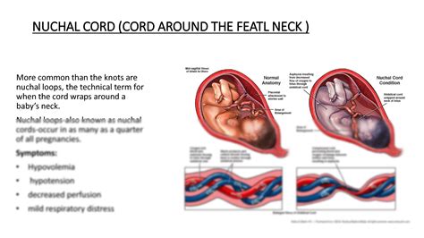 SOLUTION: Umbilical cord knots pathology - Studypool