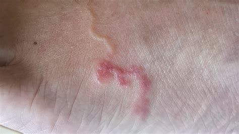 Hookworm Skin Infection