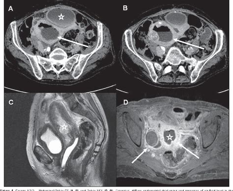 Pelvic Inflammatory Disease Ct Scan