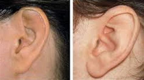 Are Your Ear Lobes Attached? | The-Health-Focus by Quantum Healing ...