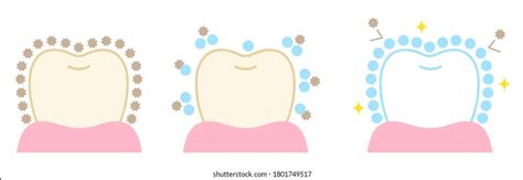 Tooth Bleaching Before After Illustration Isolated Stock Vector (Royalty Free) 1801749517 ...