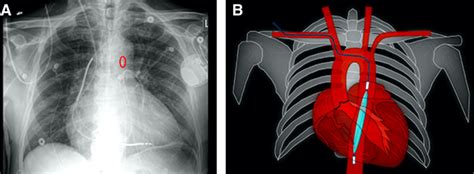 Intra Aortic Balloon Pump Chest X Ray