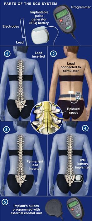 Spinal Cord Stimulator Implant - The Southeastern Spine Institute