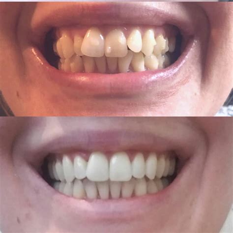 Before and after - 14 aligner trays and 13 refinement trays :D - finished today. : r/Invisalign