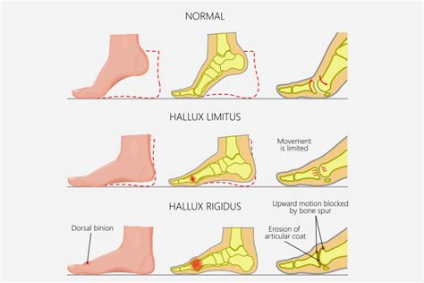 Arthritis in the Big Toe: Causes, Symptoms and Treatment (Hallux Rigidus)