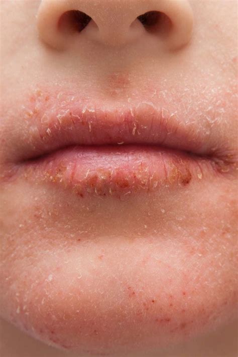 Dry skin around the mouth: Causes, treatment, and remedies