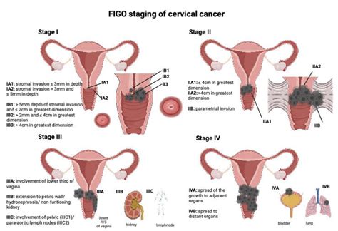 Cervical Cancer Challenge