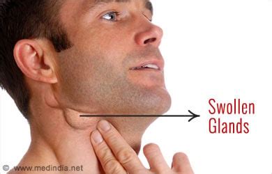 Swollen Glands - Symptom Evaluation