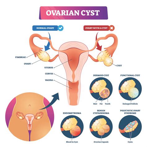 Fibroids vs. Cysts: What's the Difference? - Responsum for Fibroids