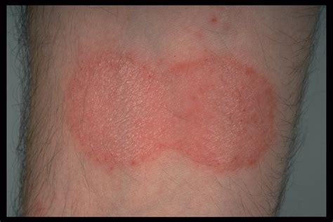 discoid eczema treatments - pictures, photos