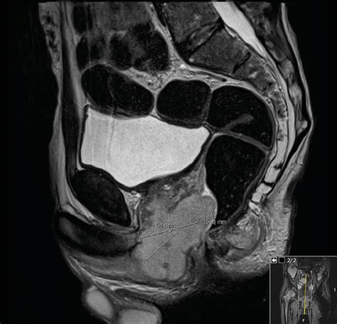 Interval increase in size of the large prostatic abscess which now is... | Download Scientific ...