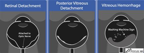 Intern Ultrasound of the Month: Retinal Detachment — University Hospitals Emergency Medicine ...