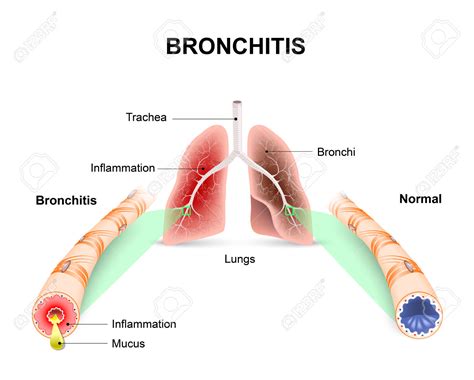 Bronchial tubes clipart 20 free Cliparts | Download images on Clipground 2024