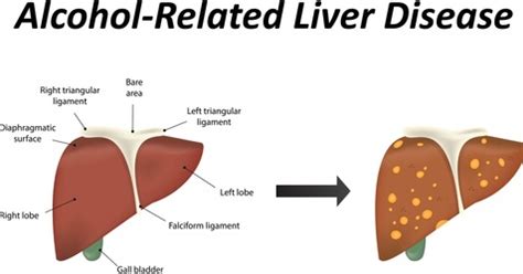 Alcoholic Liver Disease - Understanding Alcohol And Liver Disease