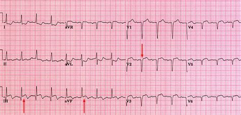 Step 8: Assess Q waves and determine significance